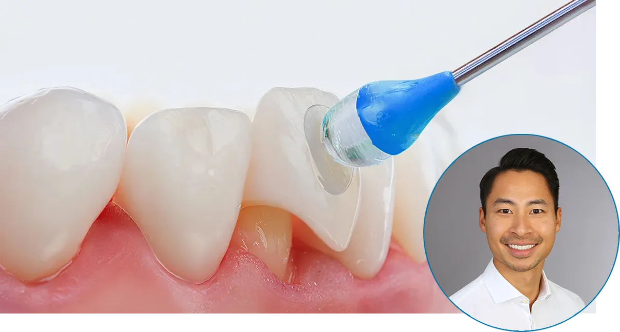 Adhäsive Befestigung einer vollkeramischen Restauration mit Dr. Yosy